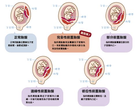 胎盤前置|前置胎盤